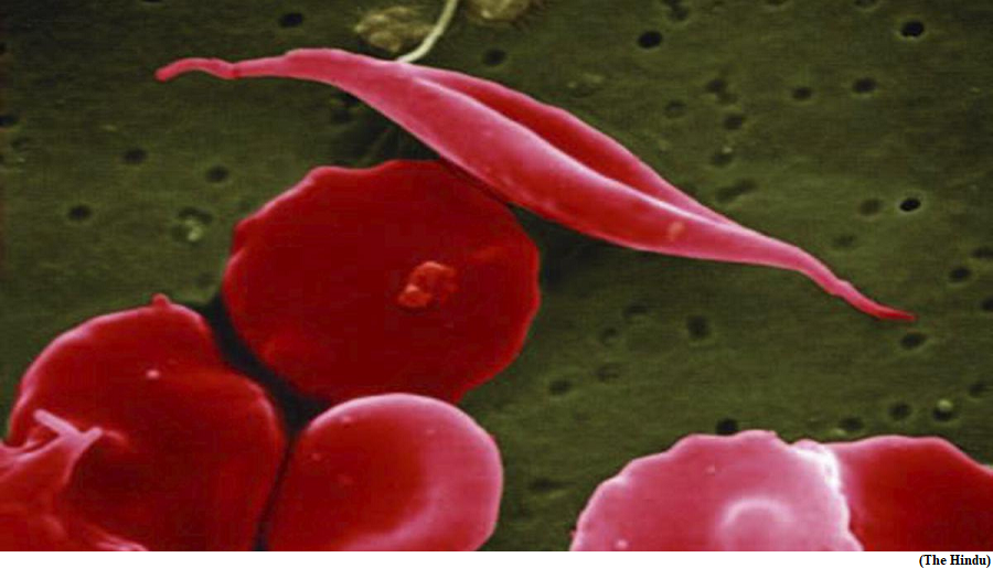 U.S. FDA approves pair of gene therapies for sickle cell disease (GS Paper 2, Health)