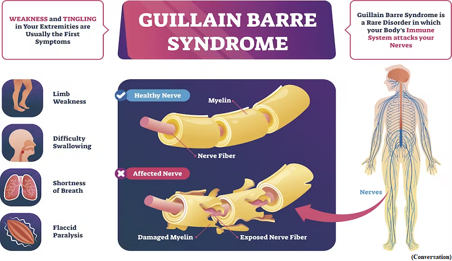 Guillain-Barre, What is this neurological disorder and how is it linked to COVID 19 (GS Paper 2, Health)